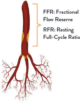 Determining the Need for Revascularisation