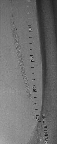 Long, Calcified Superficial Femoral Artery