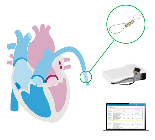 How the CardioMEMS System works