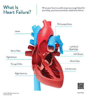 Heart Failure poster