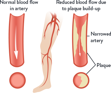 What is peripheral artery disease (PAD)?