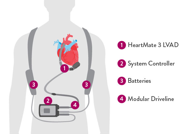 HeartMate 3 LVAD components