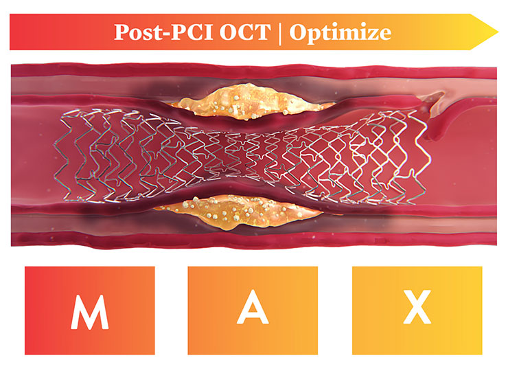  Post-PCI OCT Optimize