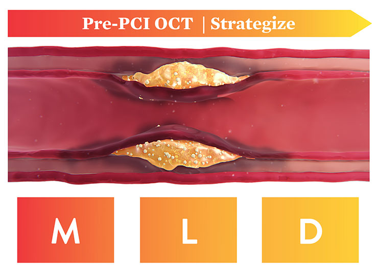  Pre-PCI OCT Strategize