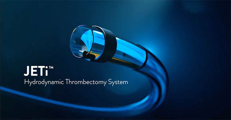 JETi Hydrodynamic Thrombectomy System