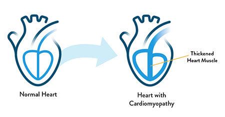 What is Cardiomyopathy?